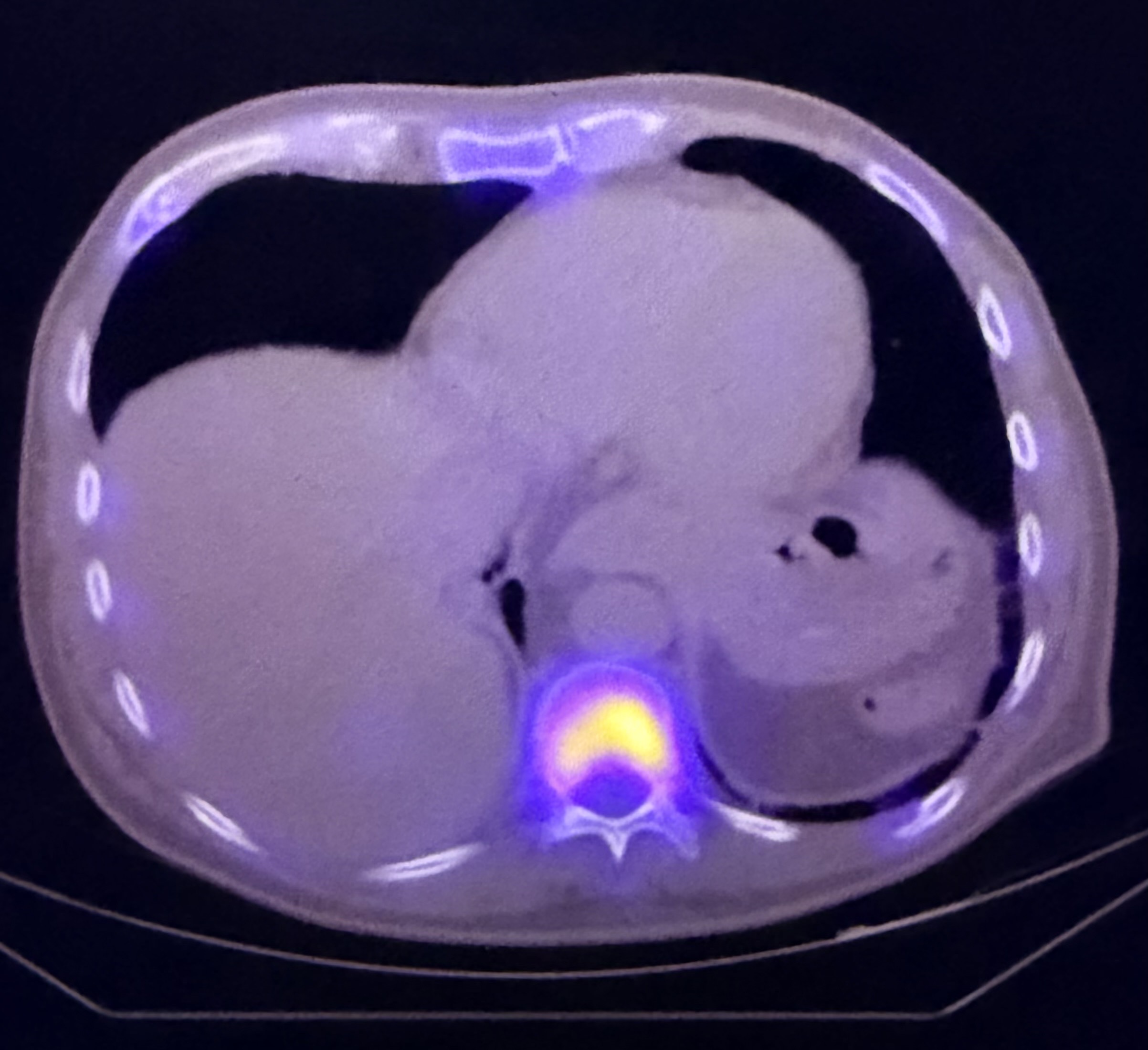 PET/CT example used to illustrate lymphoma staging and response assessment